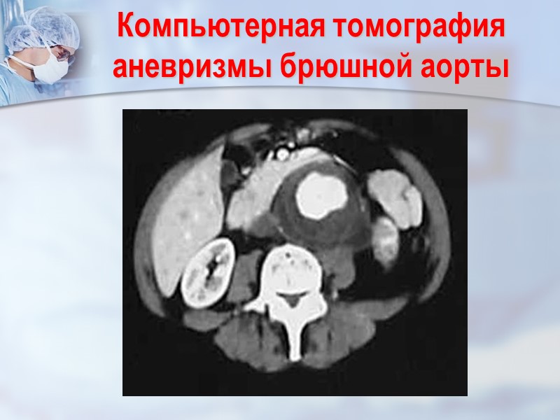 Компьютерная томография аневризмы брюшной аорты